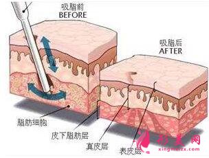 　大腿抽脂填充臉部手術(shù)風險大不大？