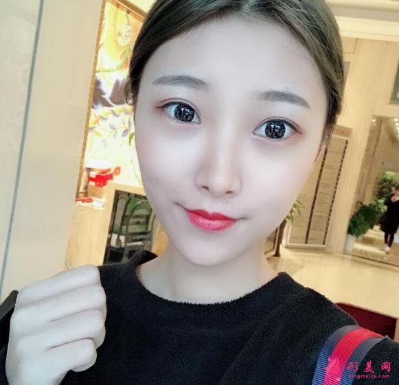 深圳回來醫(yī)療整形醫(yī)院脂肪填充案例，院長技術(shù)很不錯(cuò)~
