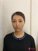 武漢美加壹整形醫(yī)院做脂肪填充好不好？附2020價格表和案例分享