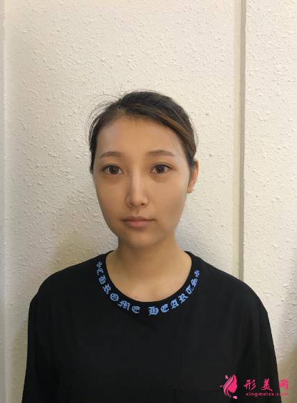 深圳回來醫(yī)療整形醫(yī)院脂肪填充案例，院長技術(shù)很不錯(cuò)~