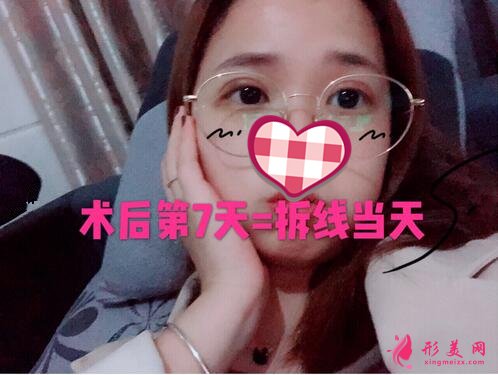 深圳米蘭柏羽做眼睛多少錢