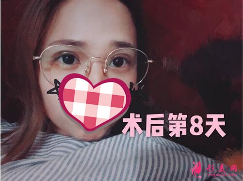 深圳米蘭柏羽做眼睛技術好不好 雙眼皮案例