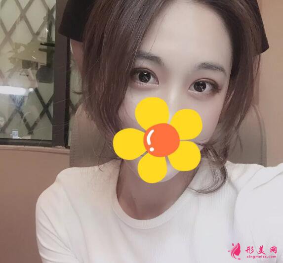 深圳米蘭柏羽雙眼皮價格 手術效果圖