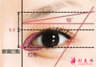 開(kāi)眼角一般需要多少錢