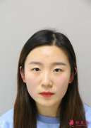北京301醫(yī)院開雙眼皮那個醫(yī)生做的好？整形案例效果分享