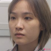 沈陽(yáng)陸軍總醫(yī)院整形科怎么樣？隆鼻案例分享！