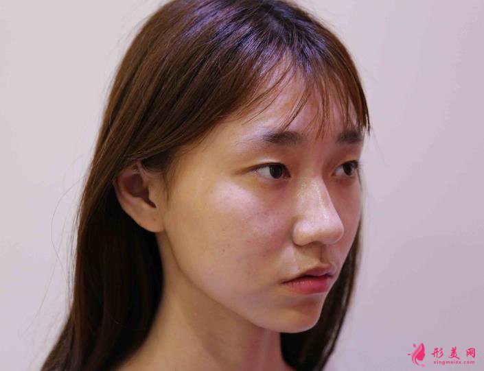 深圳銘醫(yī)張青松案例：雙眼皮案例之小姐姐的美麗蛻變