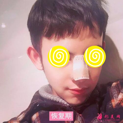 【案例】深圳人民醫(yī)院隆鼻案例，三甲技術(shù)確實(shí)不錯(cuò)！
