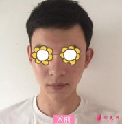 南京南醫(yī)二附院隆鼻怎么樣？整形價(jià)格表及案例分享