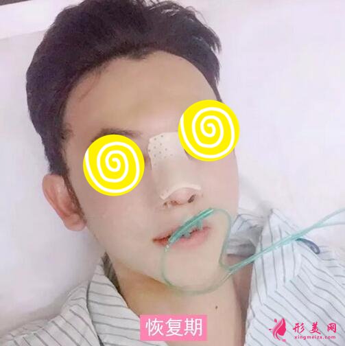 【案例】深圳人民醫(yī)院隆鼻案例，三甲技術(shù)確實(shí)不錯(cuò)！