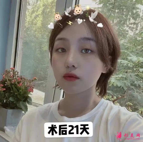 李信鋒做鼻子怎么樣？看看案例圖就知道醫(yī)生技術(shù)了