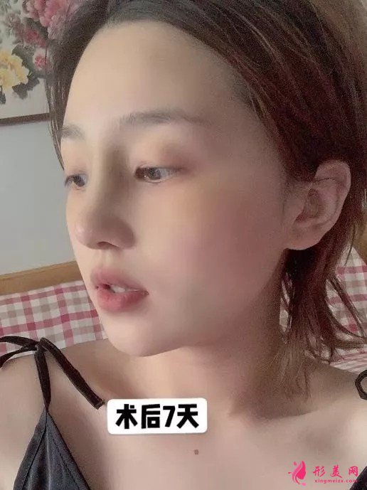 李信鋒做鼻子怎么樣？看看案例圖就知道醫(yī)生技術(shù)了