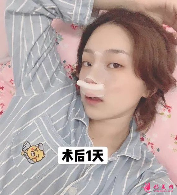 李信鋒做鼻子怎么樣？看看案例圖就知道醫(yī)生技術(shù)了