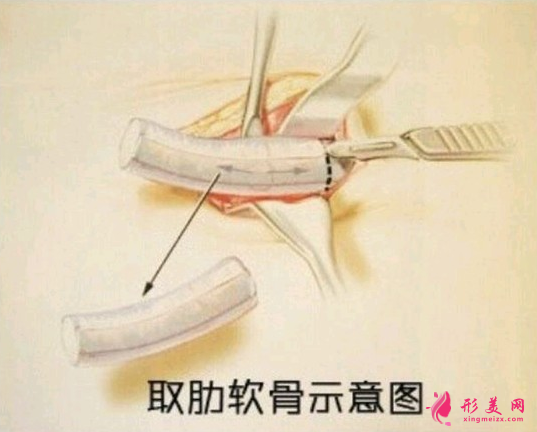自體軟骨隆鼻