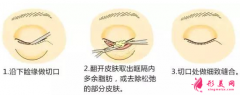 手術(shù)切除眼袋術(shù)后需要注意什么？