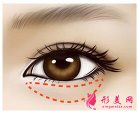 術(shù)后需要注意什么