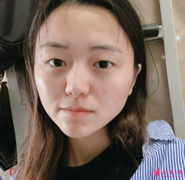 全新！深圳鵬愛醫(yī)療美容醫(yī)院割雙眼皮案例，效果圖~