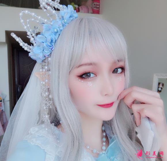 深圳美加美醫(yī)療美容雙眼皮術(shù)后5個(gè)月