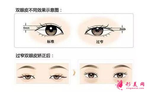 哪些表現(xiàn)證明雙眼皮手術(shù)失敗了？