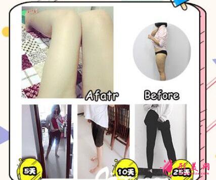 大腿抽脂填充臉部手術(shù)風(fēng)險有哪些？
