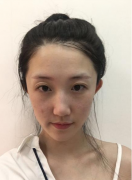 成都西區(qū)醫(yī)院做激光祛斑怎么樣？靠譜嗎？祛斑案例分享