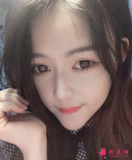 深圳利美康西一諾整形醫(yī)院隆鼻多少錢(qián) 價(jià)格 效果圖