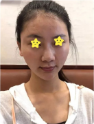 深圳米蘭柏羽美容醫(yī)院隆鼻哪個(gè)醫(yī)生好？附案例分享