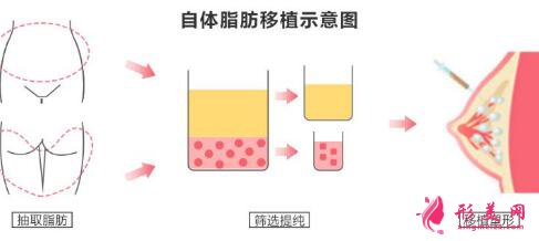 抽脂填胸多少錢?