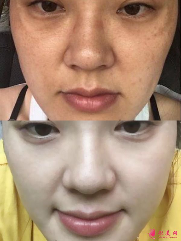 激光嫩膚美白效果好不好?