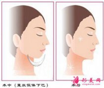 北京隆下巴大概需要多少錢？