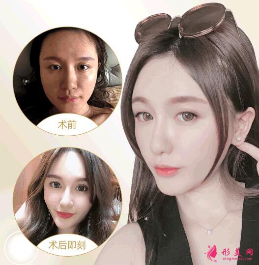 鼻子玻尿酸填充不吸收是真的嗎?