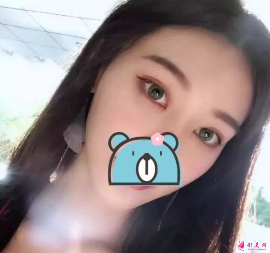 深圳陽光醫(yī)院雙眼皮案例，單眼皮妹子的完美逆襲