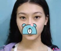 北京八大處靳小雷雙眼皮怎么樣？單眼皮妹子的完美逆襲