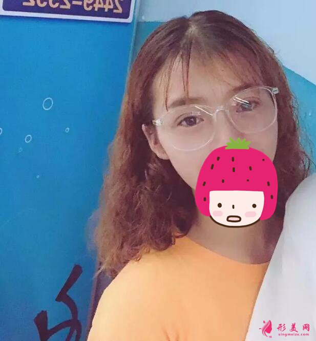 深圳美萊梁志為雙眼皮案例，做個雙眼皮“改頭換面”
