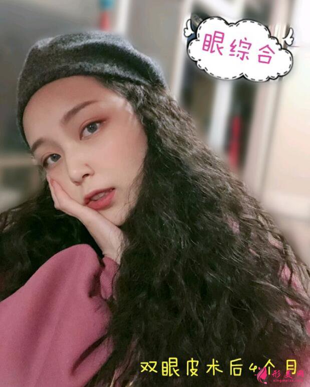 深圳鵬愛(ài)醫(yī)療美容醫(yī)院割雙眼皮案例反饋