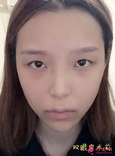 深圳鵬愛(ài)醫(yī)療美容醫(yī)院割雙眼皮案例反饋