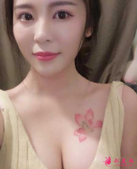去八大處找張智勇做假體隆胸手術(shù)后兩個(gè)半月