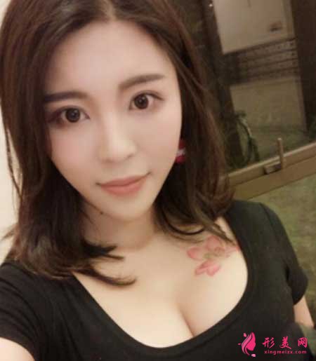 去八大處找張智勇做假體隆胸手術(shù)后1個(gè)月