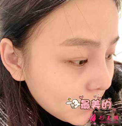 找成都華美紫馨陳楊醫(yī)生做鼻綜合術(shù)后7天
