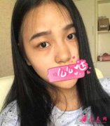深圳博愛醫(yī)院整形美容科鼻綜合手術(shù)怎么樣？鼻綜合案例分享