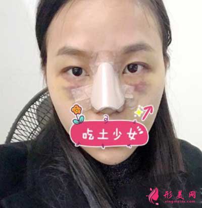 找成都華美紫馨陳楊醫(yī)生做鼻綜合術(shù)后第2天