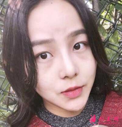 找成都華美紫馨陳楊醫(yī)生做鼻綜合術(shù)后30天