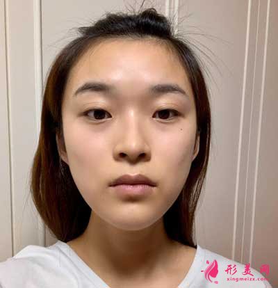 去北京葉子整形醫(yī)院找李明做磨下頜角手術(shù)后12天