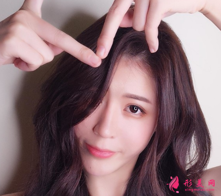 北醫(yī)三院閆愛萍為我做的雙眼皮 術(shù)后60天效果恢復(fù)實(shí)在是太自然了