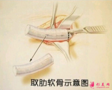 肋軟骨隆鼻以后要更換嗎