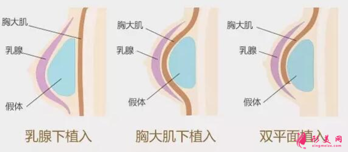 假體隆胸后會(huì)下墜嗎