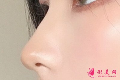 鼻假體取出后多久恢復