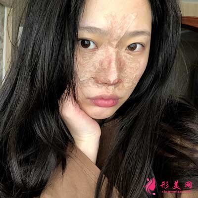做隆鼻整形手術(shù)的術(shù)后即刻照片分享