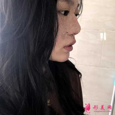 到雅美整形醫(yī)院做的隆鼻整形手術(shù) 術(shù)后第2天效果圖分享