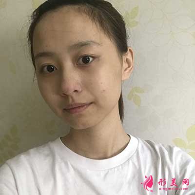 王繼紅醫(yī)生給我做的鼻子 術(shù)后第7天拆線了